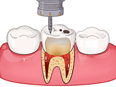 根管預備、消毒