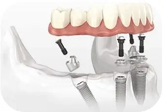醫師定制種植方案