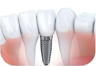 數字化種植有效改善種植難度