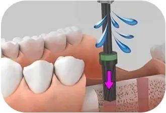 製作牙齒的全瓷修復