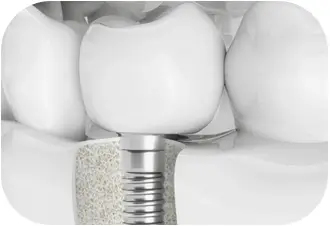 數字化種牙 即種即用