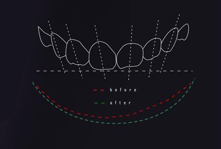 牙貼片為何需要DSD數字微笑設計？