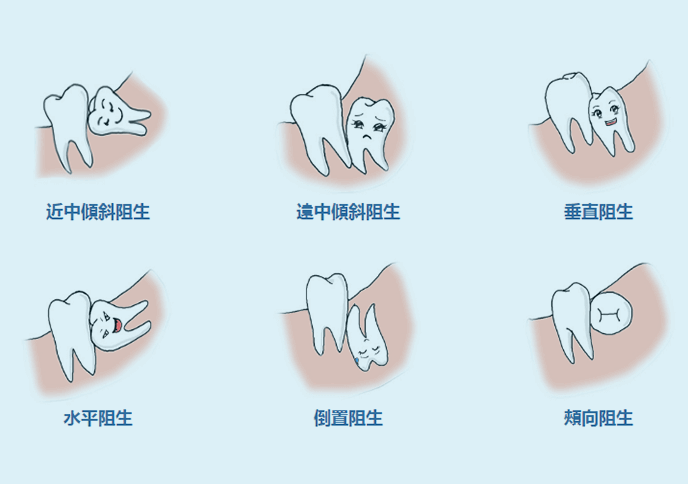 珠海拔牙介紹