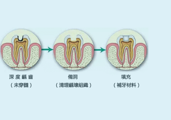 珠海補牙