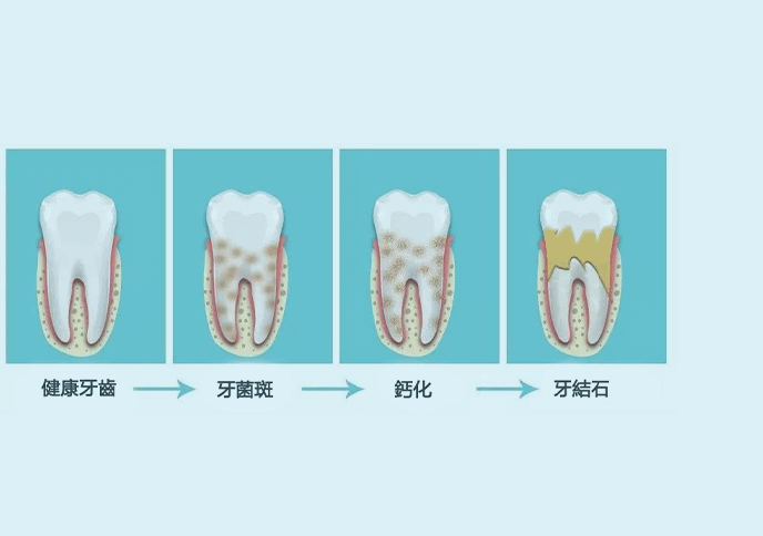 拱北洗牙