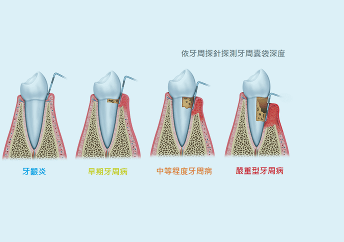 珠海洗牙