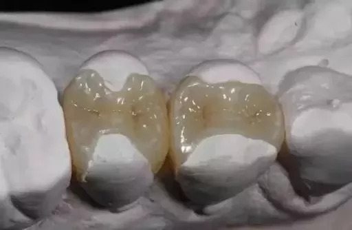 牙医建议我选择嵌体修复 什么是嵌体