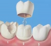 珠海牙科—為什麼做烤瓷牙要磨除部分天然牙？