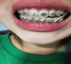 珠海箍牙-吃飯習慣不良可致小孩牙齒畸形嗎？