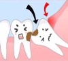 珠海牙科——阻生牙有哪些危害？