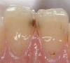 珠海牙科—為什麼發現蛀牙要及時補牙？
