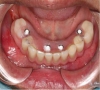 珠海牙科—無牙頜種植需要注意哪些內容？