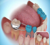 珠海牙科—乳牙提前脫落怎麼辦？