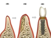 珠海植牙—缺牙太久牙齒萎縮可以做種植牙嗎？