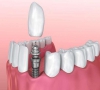 珠海牙科—為什麼有些人的種植牙會失敗？