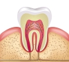 珠海牙科—牙髓炎多久牙髓能壞死？