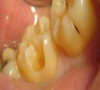 珠海牙科—牙齒缺一塊怎麼辦？