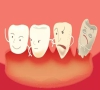 珠海牙科—牙齒鬆動就需要拔掉嗎？