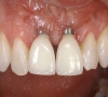 珠海牙科—種植牙脫落該怎麼辦？