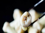 咩因素會導致剝牙嘅難度增大咧？澳門去珠海剝牙收費？
