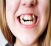 珠海牙科—兒童的牙齒為什麼容易長歪？