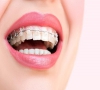 珠海箍牙-哪些錯頜畸形需要早期矯正？