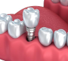 珠海牙科—做了種植牙會影響核磁共振嗎？