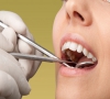 珠海牙齒美白—牙齒脫色漂白技術有哪些？
