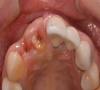 珠海牙科—牙齒爛剩殘根要不要管？