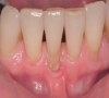 珠海牙周治療—治療牙周病都有什麼方法？