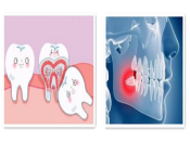 牙痛嘅原因有邊啲？珠海牙痛治療要幾錢？