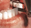 珠海箍牙—牙齒矯正片切適應症和禁忌症有哪些情況？