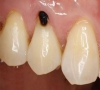 珠海牙科洗牙- 洗牙會使牙齒鬆動嗎？