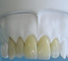 珠海牙科科普-烤瓷牙修復後要注意什麼？