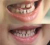 珠海牙科—乳牙牙縫大會影響恒牙嗎？