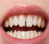  珠海牙科—為什麼牙縫會越來越大？