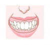 珠海牙齒矯正—前牙深覆頜常用的矯治方法有哪些？