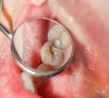 怎麼預防牙髓炎？