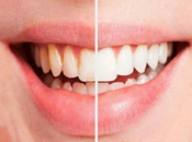 珠海牙齒美白—做完牙齒美白可以持續多久？