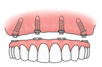 珠海半口植牙，All-on-4種植牙幾錢？