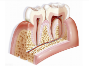 根尖周炎係咩咧？珠海杜牙根要幾錢？