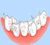 珠海牙科—有哪些方法可以診斷牙列擁擠？