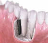 珠海牙科—種植牙為什麼可以媲美真牙呢？