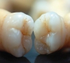 珠海牙冠—為什麼我的烤瓷牙邊緣會發黑？
