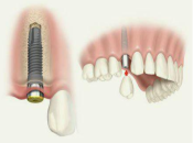 珠海植牙，什麼情況適合進行即剝即種手術?