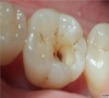 珠海牙科-為什麼“六齡牙”是容易得齲病的牙？