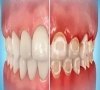 珠海牙科—牙齒礦化和牙齒脫礦有什麼區別嗎？