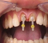 珠海牙科—牙齒打樁用什麼材料好？
