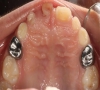 珠海牙科—乳牙不銹鋼金屬預成冠修復是什麼？