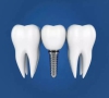 珠海牙科—固定義齒與活動義齒的區別是什麼？